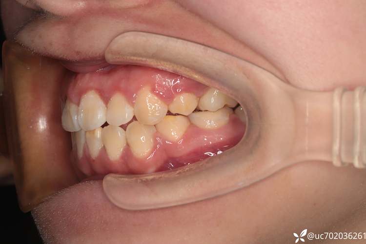 正畸拔牙一个月效果图效果如何?变化大不大?-图2 正畸拔牙一个月效果图效果如何?变化大不大?-图2