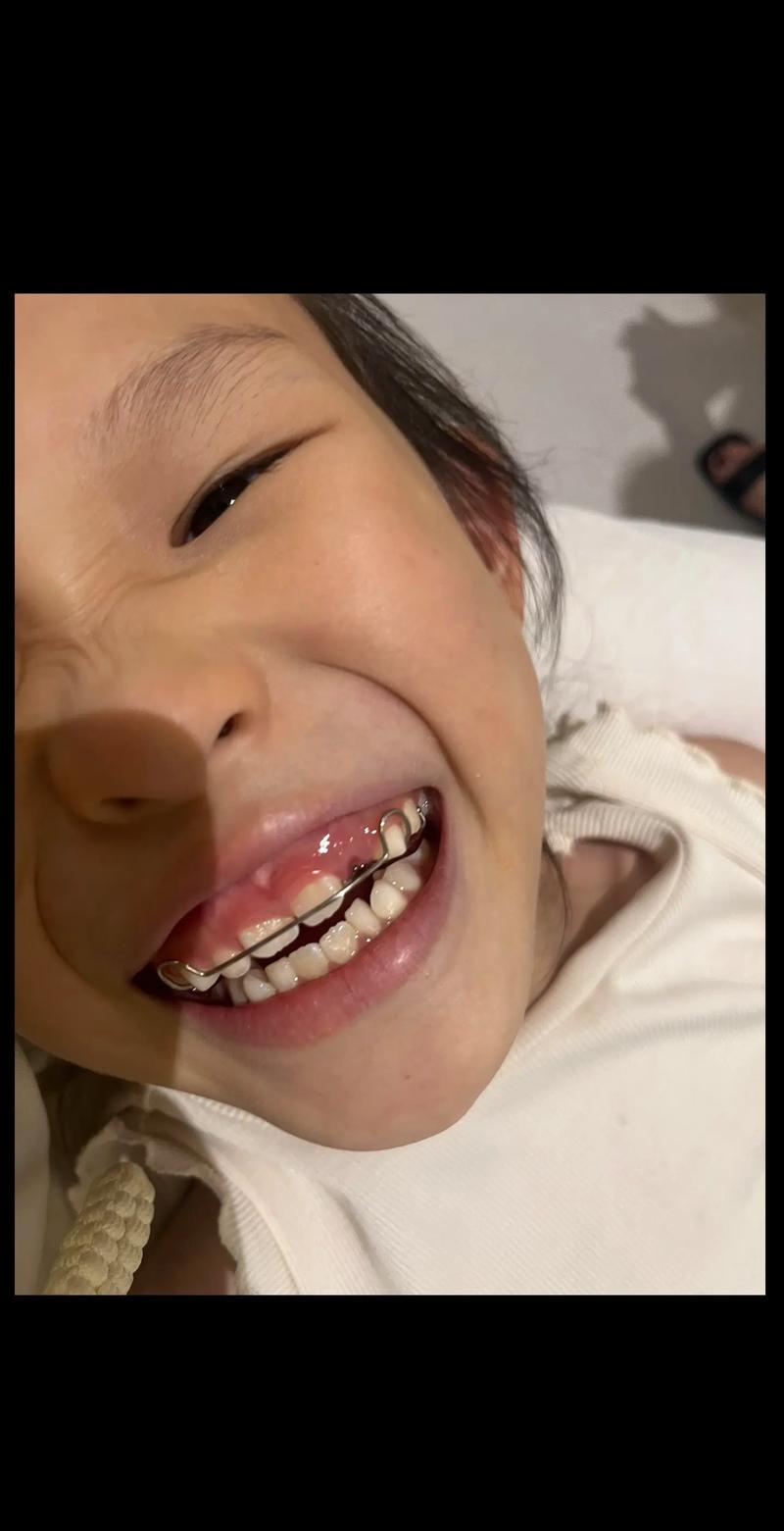 正畸拔牙一个月效果图效果如何?变化大不大?-图1 正畸拔牙一个月效果图效果如何?变化大不大?-图1