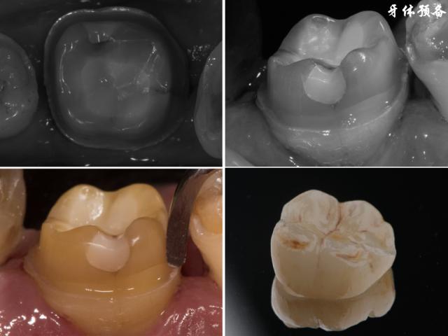黄叶君前牙的预备方法-图1 黄叶君前牙的预备方法-图1