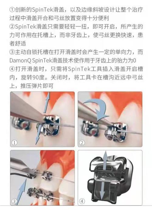 矫正方法中进口金属托槽矫正效果具体比普通托槽更好呢?-图1 矫正方法中进口金属托槽矫正效果具体比普通托槽更好呢?-图1