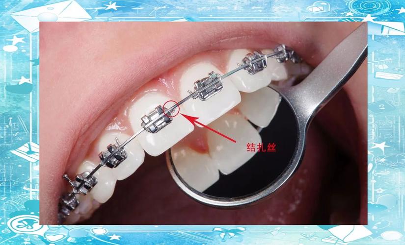 矫正方法中进口金属托槽矫正效果具体比普通托槽更好呢?-图3 矫正方法中进口金属托槽矫正效果具体比普通托槽更好呢?-图3
