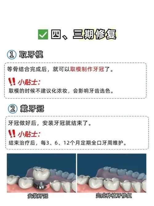 一次种牙能用多长时间-图3 一次种牙能用多长时间-图3