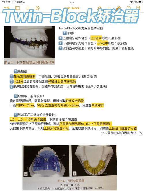 正畸二类二分类矫治的关键难点与突破点是什么?-图3 正畸二类二分类矫治的关键难点与突破点是什么?-图3