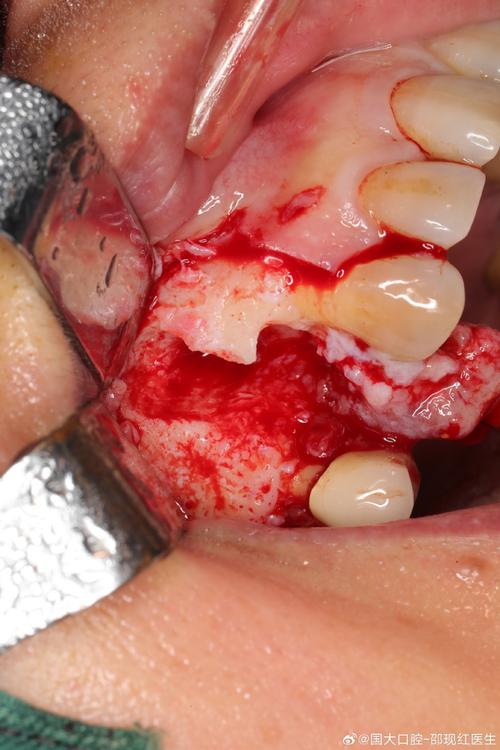 种牙种植体上面长出肉-图3 种牙种植体上面长出肉-图3