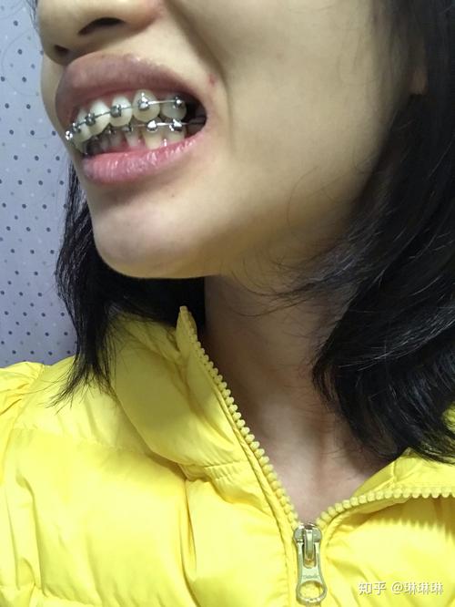 正畸复查延迟一个月，原因及影响如何？-图3