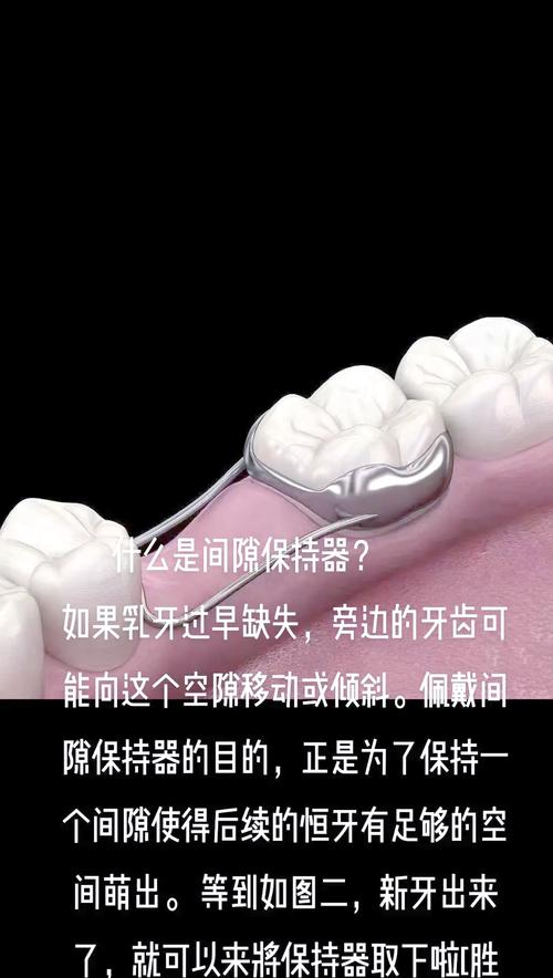 牙齿保持器的正确保管方法有哪些关键要点？-图1