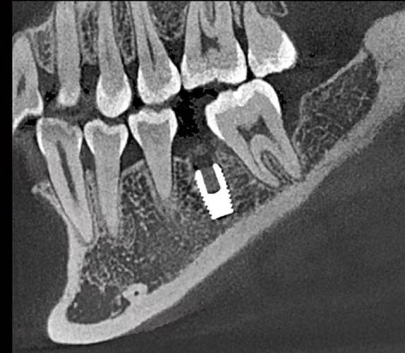 种牙CT检查的危害具体有哪些？-图2