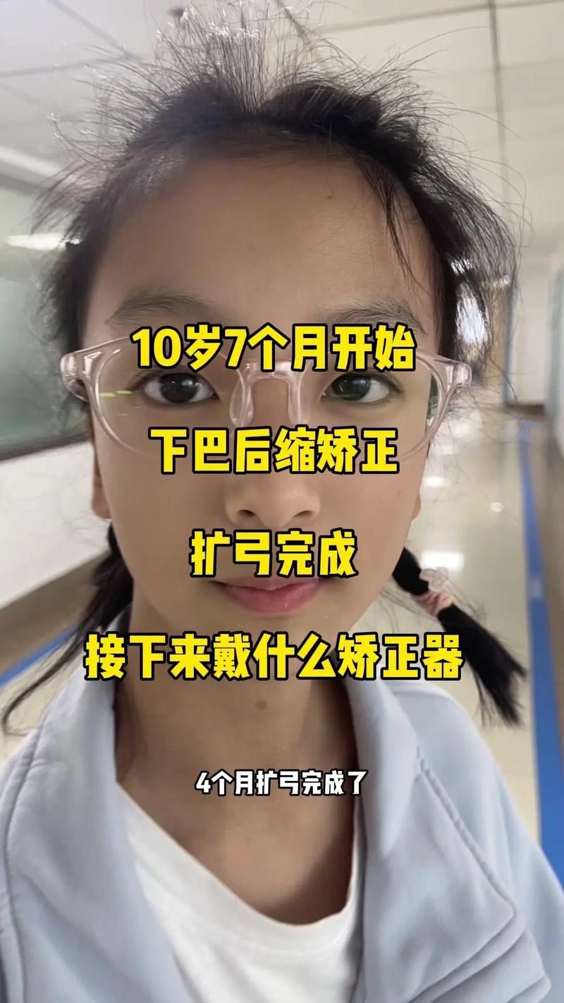 正颌术前正畸四个月时长够用吗？效果能达标吗？-图2