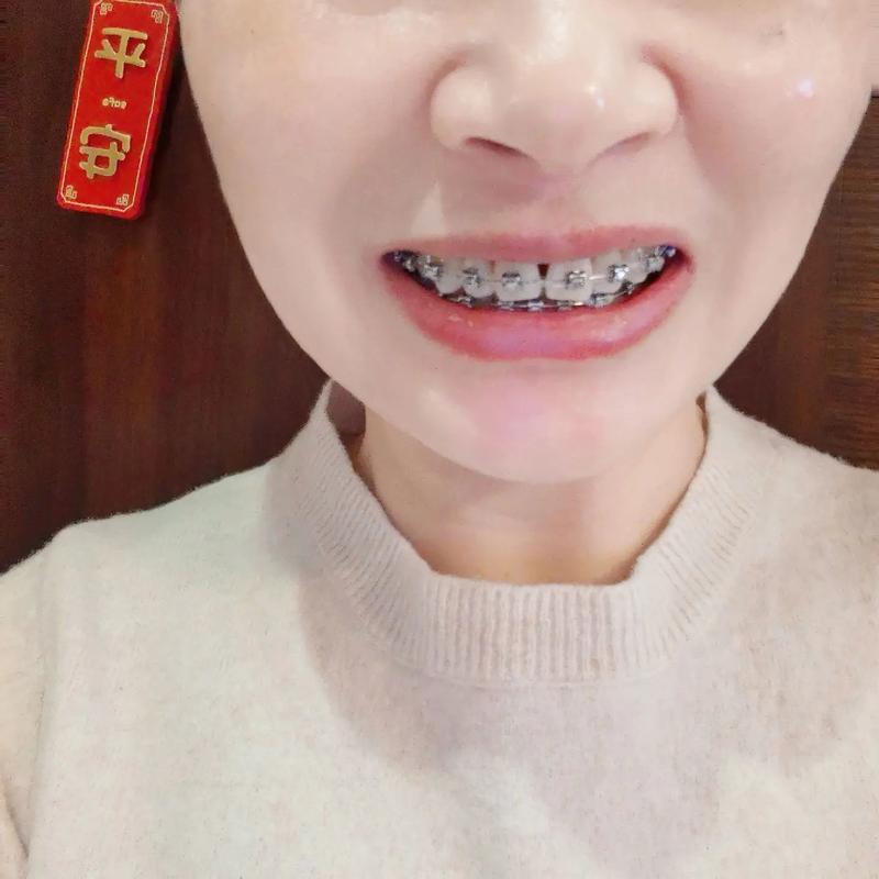 正颌术前正畸四个月时长够用吗?效果能达标吗?-图1 正颌术前正畸四个月时长够用吗?效果能达标吗?-图1