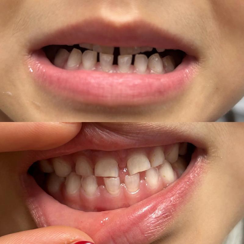 正颌术前正畸四个月时长够用吗?效果能达标吗?-图3 正颌术前正畸四个月时长够用吗?效果能达标吗?-图3