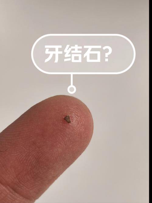 拜博口腔牙结石-图2 拜博口腔牙结石-图2