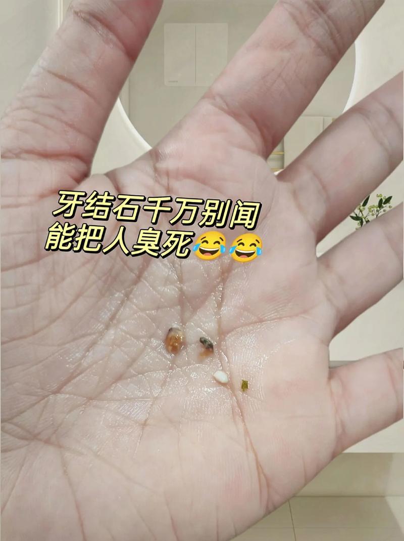 拜博口腔牙结石-图1 拜博口腔牙结石-图1