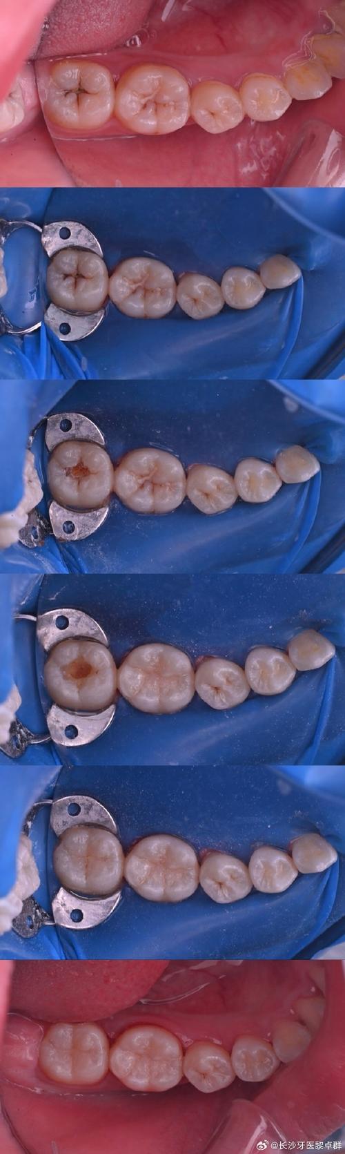 后牙形态树脂堆塑方法-图2 后牙形态树脂堆塑方法-图2