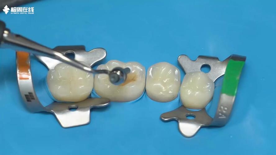 后牙形态树脂堆塑方法-图1 后牙形态树脂堆塑方法-图1