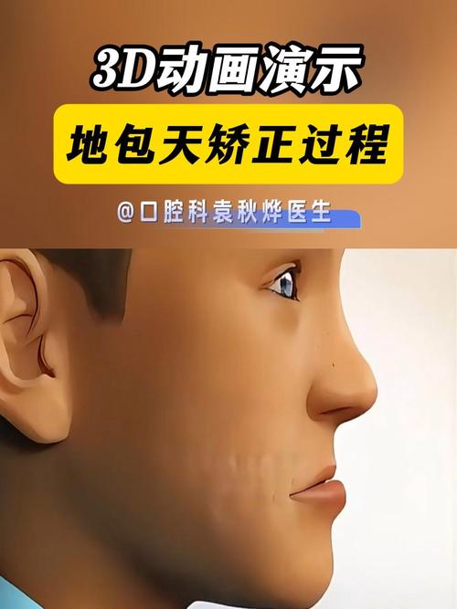 地包天矫正用什么方法-图2