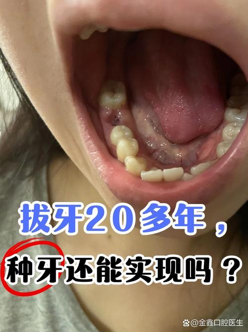 拔牙两年后还能种牙吗?时间会影响种植可行性吗?-图1 拔牙两年后还能种牙吗?时间会影响种植可行性吗?-图1