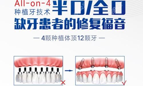 all一on一4种牙-图2