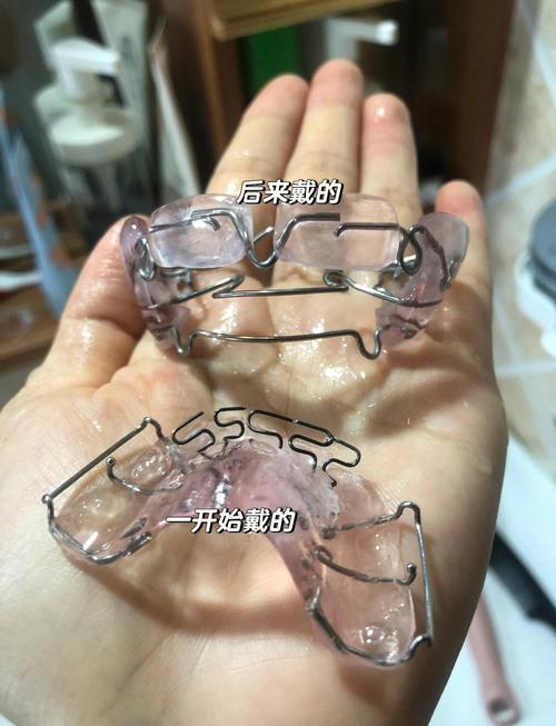 地包天牙齿矫正土方法-图1 地包天牙齿矫正土方法-图1