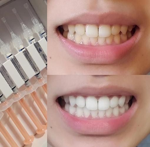 上海美白牙齿的有效方法有哪些?-图2 上海美白牙齿的有效方法有哪些?-图2