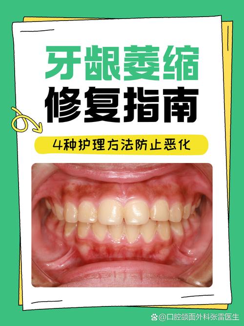 种牙后如何有效防止牙龈萎缩？-图2