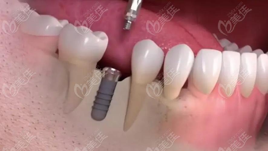 深圳哪里种牙比较好的-图3 深圳哪里种牙比较好的-图3