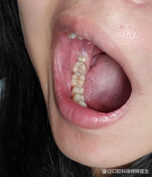 智齿未萌出就正畸,会影响矫正效果和智齿后续生长吗?-图1 智齿未萌出就正畸,会影响矫正效果和智齿后续生长吗?-图1