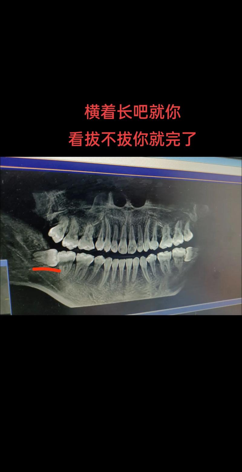 智齿未萌出就正畸,会影响矫正效果和智齿后续生长吗?-图2 智齿未萌出就正畸,会影响矫正效果和智齿后续生长吗?-图2