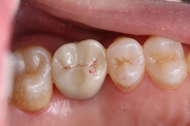 种植固定修复粘接方法-图1 种植固定修复粘接方法-图1