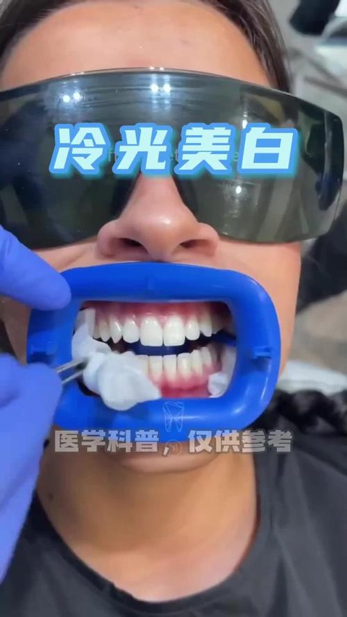 杭州冷光美白牙齿方法-图1 杭州冷光美白牙齿方法-图1