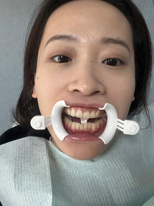 杭州冷光美白牙齿方法-图2