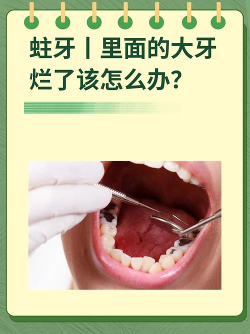 大人蛀牙如何治疗方法-图1