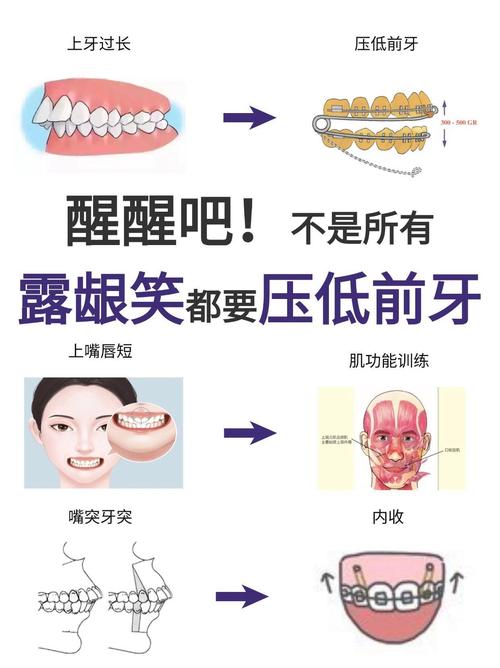 正畸压低上后牙的方法-图2