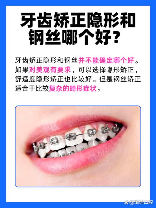 为何上合架是正畸治疗中不可或缺的重要环节？-图2