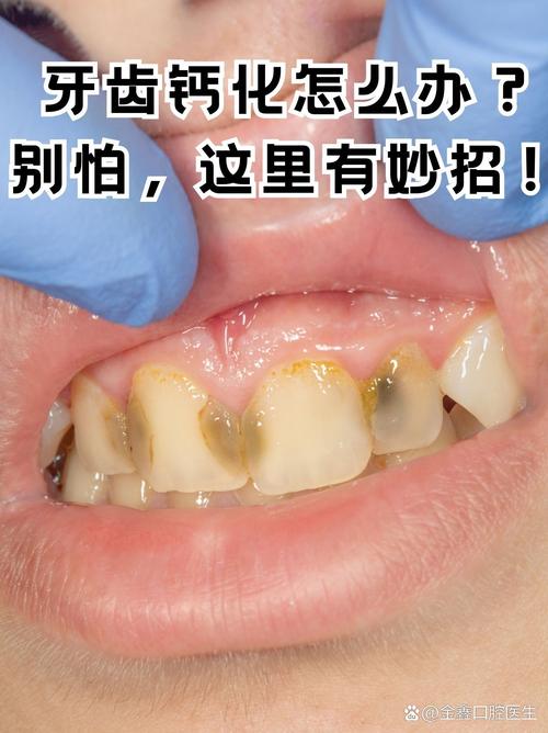 口腔钙化有哪些有效的治疗方法?-图1 口腔钙化有哪些有效的治疗方法?-图1