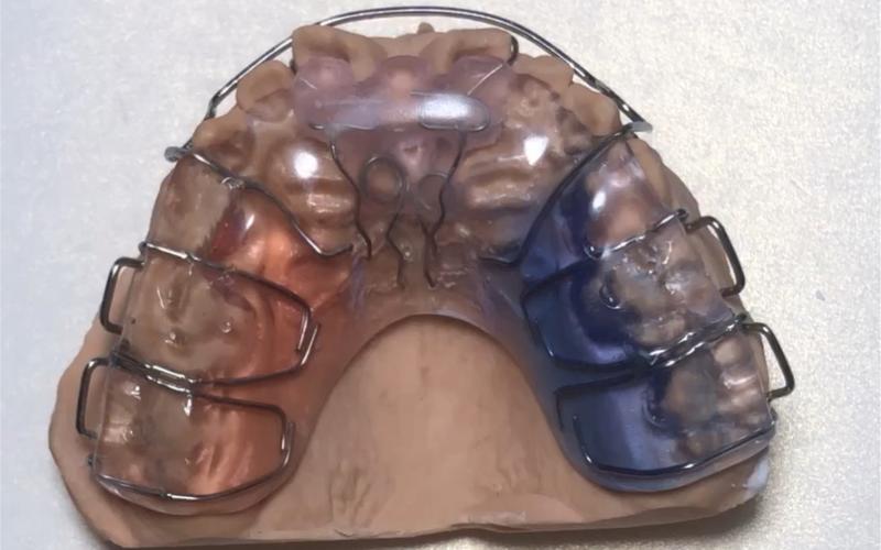 正畸舌簧矫治器的弯制需掌握哪些关键步骤与实用操作技巧？-图2