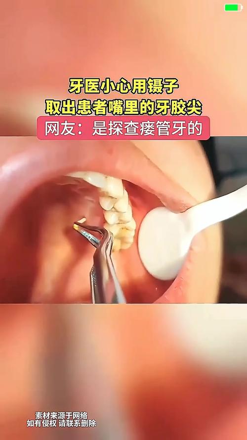 取出侧穿牙胶尖的方法-图2 取出侧穿牙胶尖的方法-图2