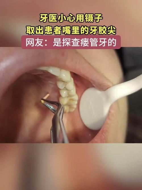 取出侧穿牙胶尖的方法-图1 取出侧穿牙胶尖的方法-图1