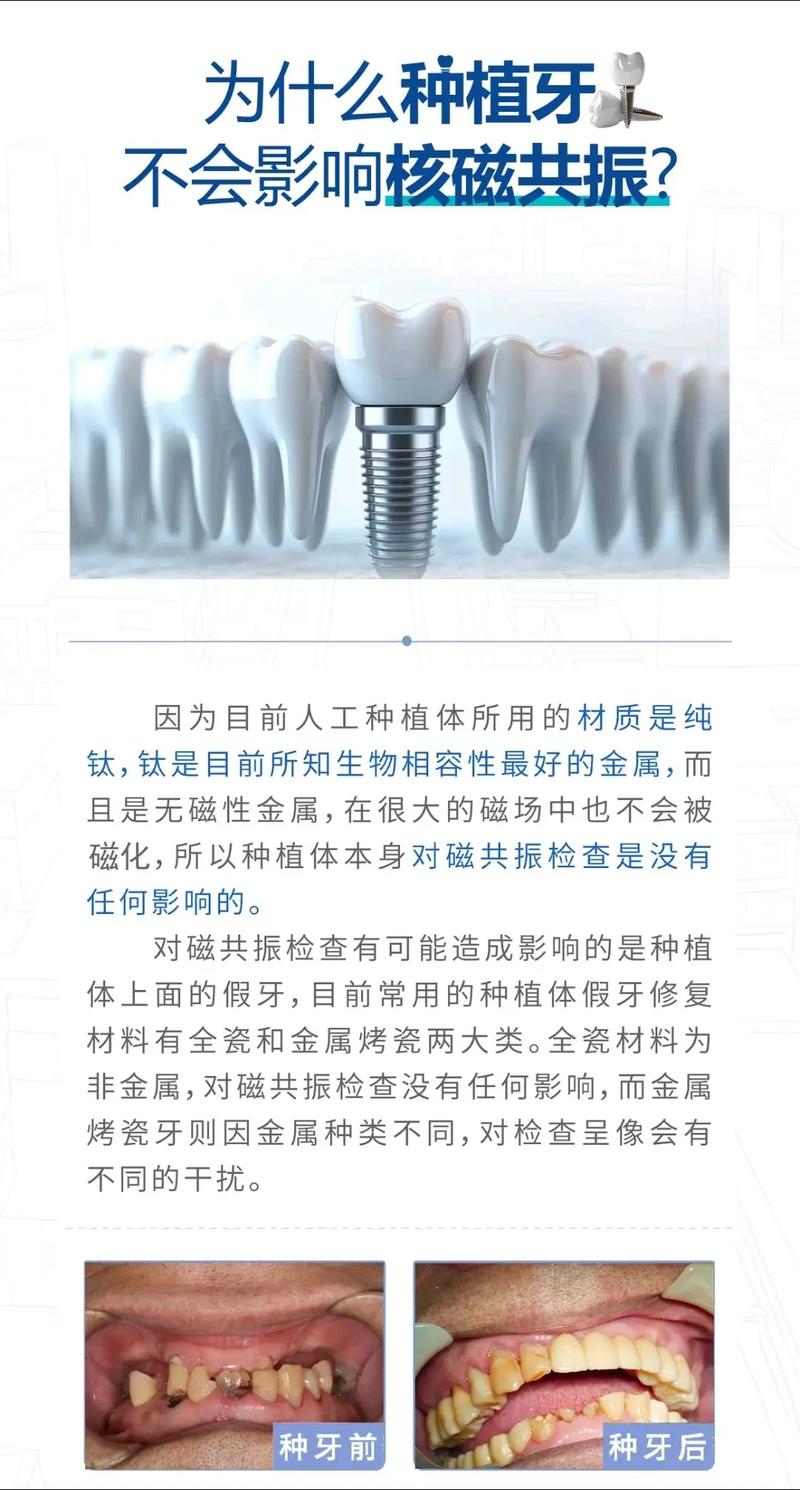 做核磁共振,种牙会有影响吗?-图2 做核磁共振,种牙会有影响吗?-图2