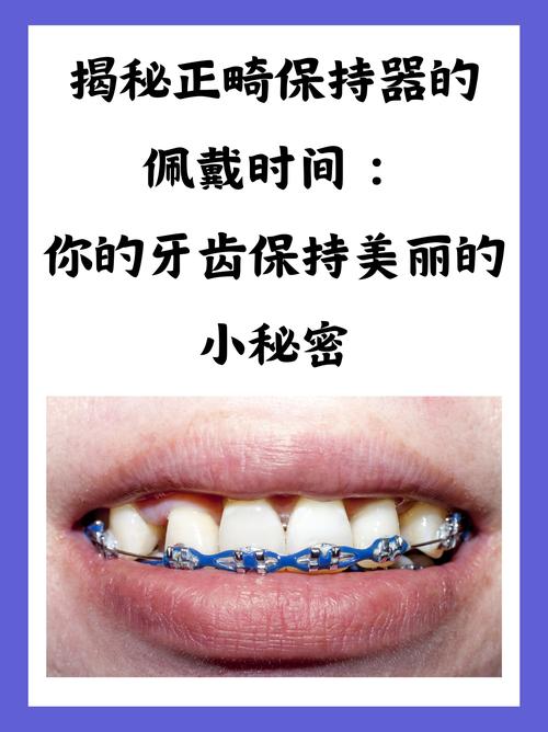 正畸要一直戴保持器么-图1 正畸要一直戴保持器么-图1