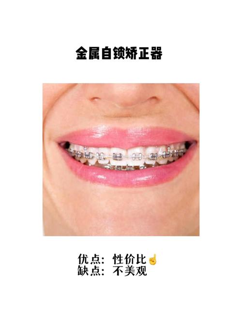 正畸要一直戴保持器么-图2 正畸要一直戴保持器么-图2
