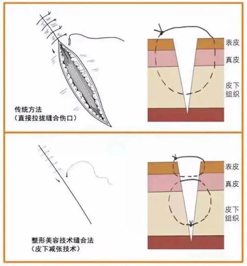下颌智齿创口缝合方法-图3 下颌智齿创口缝合方法-图3