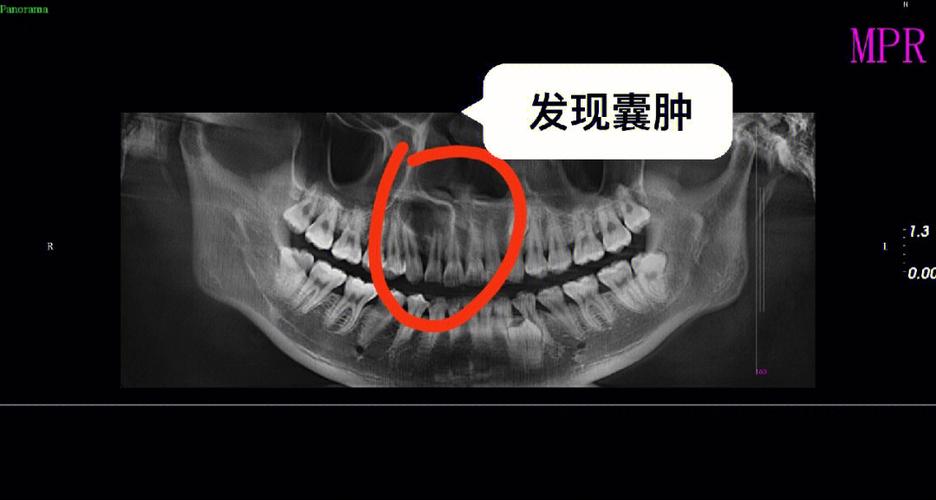 根尖囊肿术后有哪些治疗方法?如何根据病情选择最佳方案?-图1 根尖囊肿术后有哪些治疗方法?如何根据病情选择最佳方案?-图1