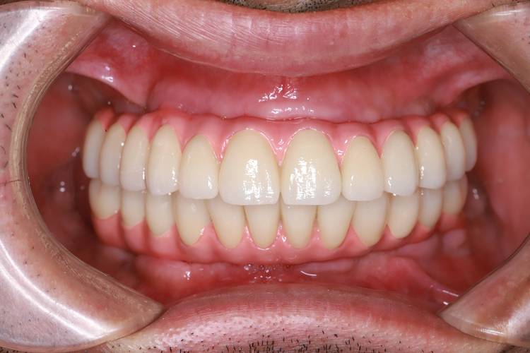 种牙费用是一次性交清还是可分期?支付方式有几种选择?-图1 种牙费用是一次性交清还是可分期?支付方式有几种选择?-图1