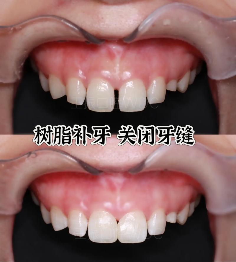 牙缝大有什么方法修补-图2