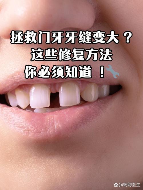 牙缝大有什么方法修补-图1