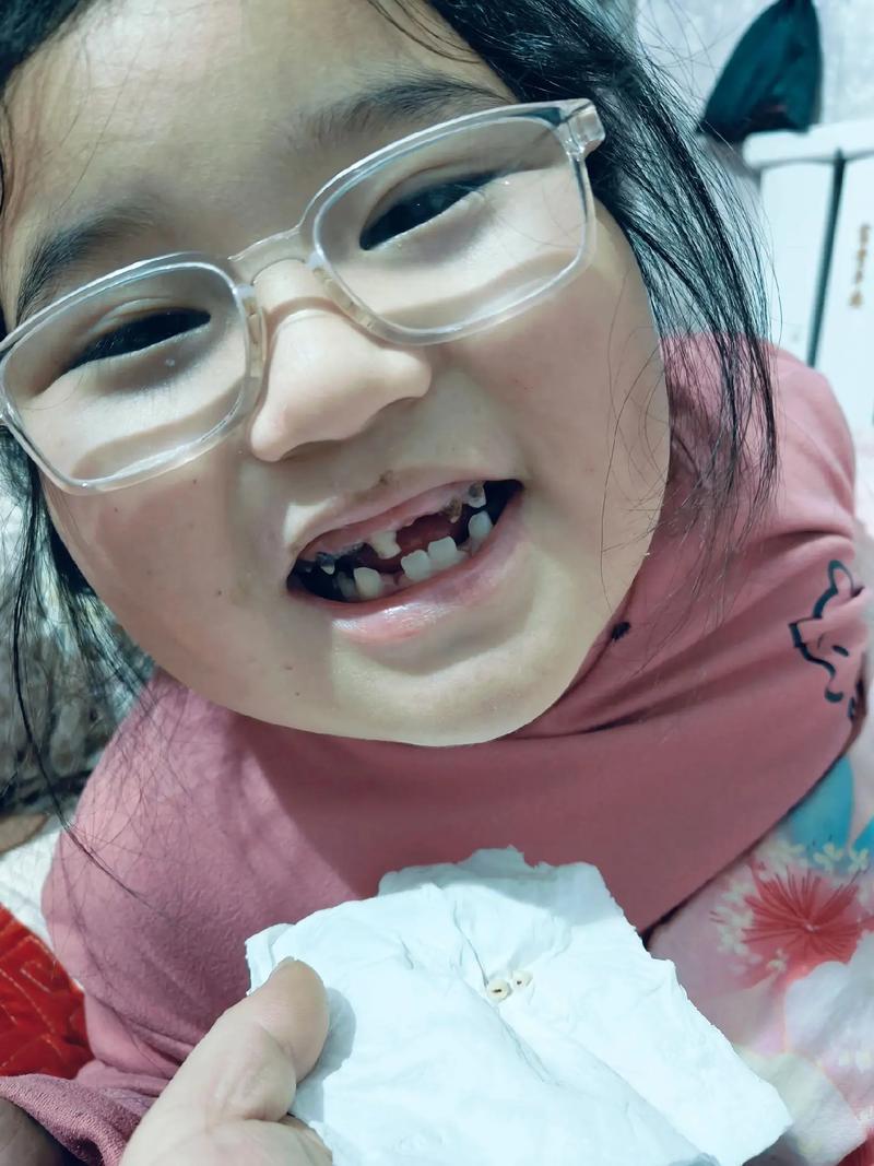 拔牙之后三个月种牙-图2