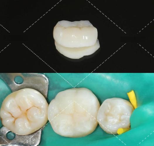 聚合瓷嵌体粘结方法的关键步骤、材料选择及注意事项有哪些？-图1