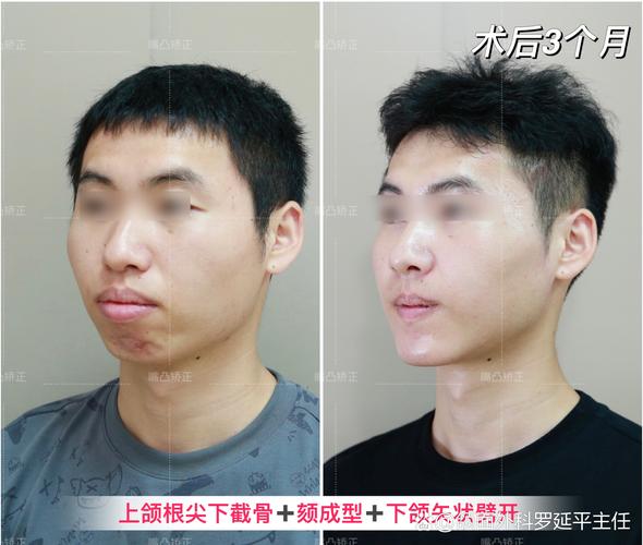 正畸跟着正颚外科一起-图1 正畸跟着正颚外科一起-图1