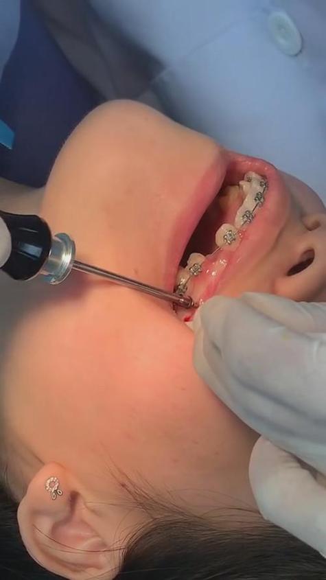 正畸二类牵引不打骨钉-图1 正畸二类牵引不打骨钉-图1