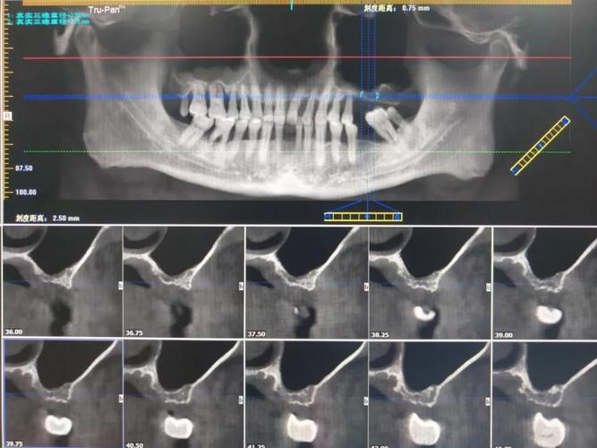 上颔窦正畸牙研究进展，临床应用面临哪些挑战与突破？-图1